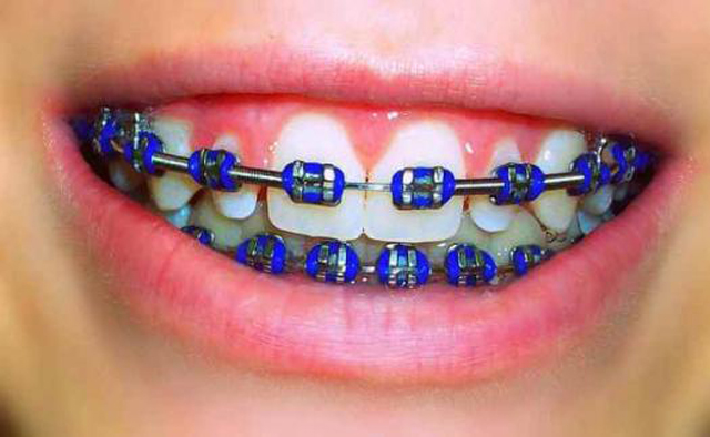 What Color Braces Can I Get?