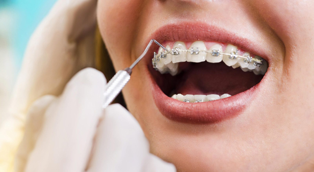 Orthodontic Care for Adults - How to Pay for Braces
