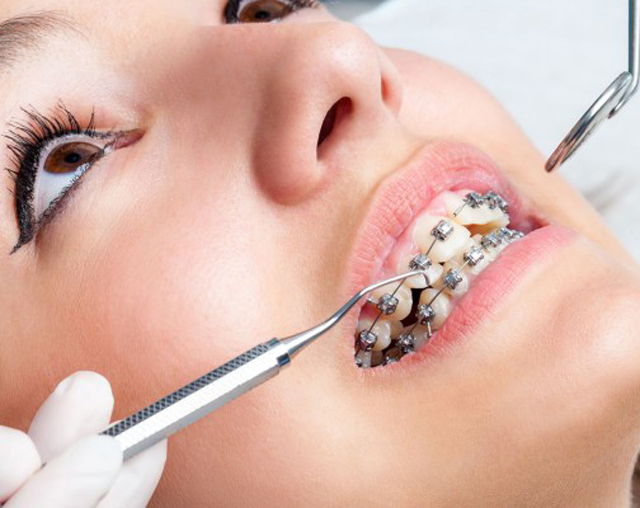 Putting on Braces: How Are Braces Put On?