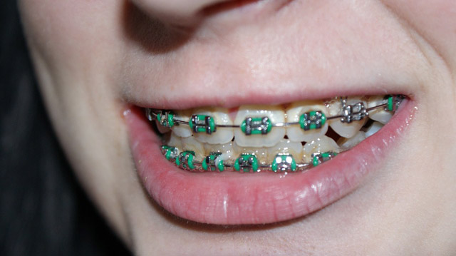 What Is The Right Age To Get Dental Braces For My Child?