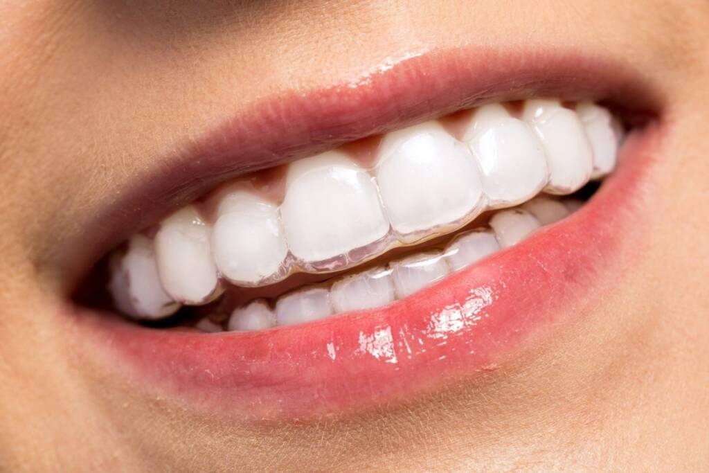 Close up mouth with Invisalign