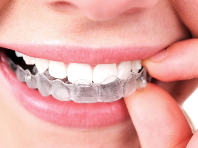 5 Benefits of Getting Invisalign