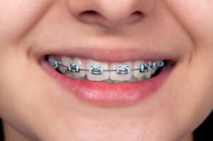 Metal Braces - Orthodontists in Dale City