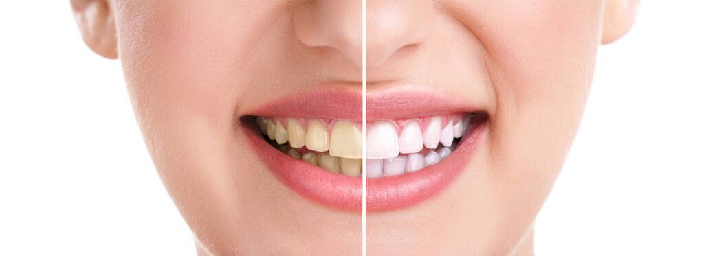  teeth whitening